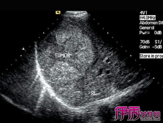 【肝癌b超表现高回声】【图】肝癌b超表现高