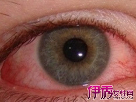 【图】眼白发红像是有层膜肿了是什么原因? 爱