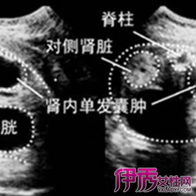 【左肾囊肿会癌变吗】【图】左肾囊肿会癌变吗