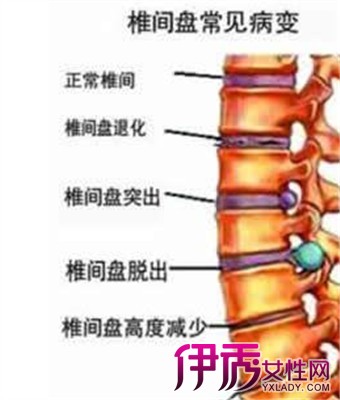 治腰间盘突出偏方有哪些 2招教你摆脱腰间盘突出的痛苦