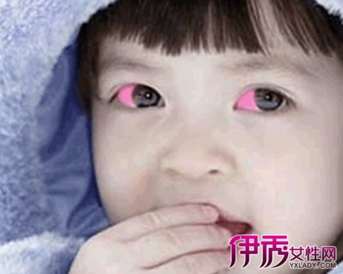 【红眼睛症状】【图】红眼睛症状有哪几种? 红