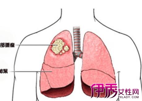 得了支气管肺癌费怎么办 教你支气管肺癌的诊断方法