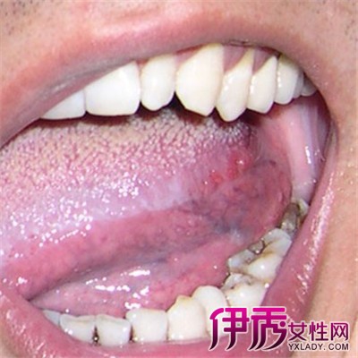 【舌根淋巴组织增生症状】【图】舌根淋巴组织