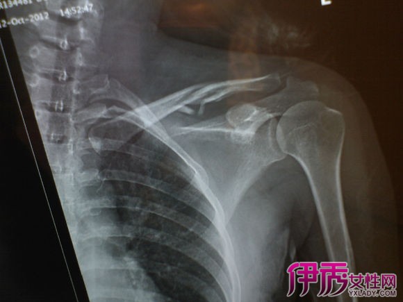 锁骨左下方疼痛就是胸壁疼痛(chestwallpain)又称肌肉骨骼疼痛