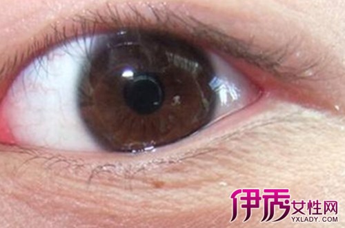 【图】一般的眼角红肿怎么回事呢 两个食疗大