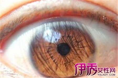 【图】眼睛有黄斑怎么回事 专家教授预防黄斑病变的方法