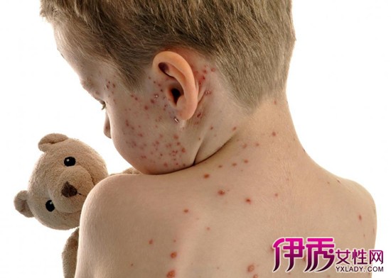 最好办法】【图】预防水痘的最好办法是什么?