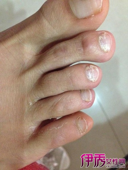 脚指甲变白是怎么回事 揭晓指甲泛白的主要病因