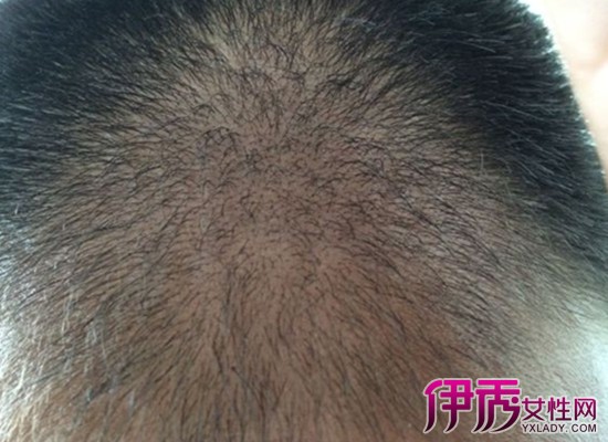 【图】头皮脂溢性皮炎会脱发吗介绍3种注意事