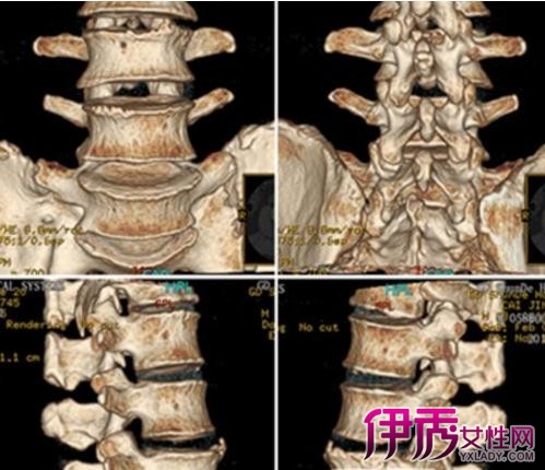 【图】腰椎结核的治疗方法有哪些 10个护理方法需注意