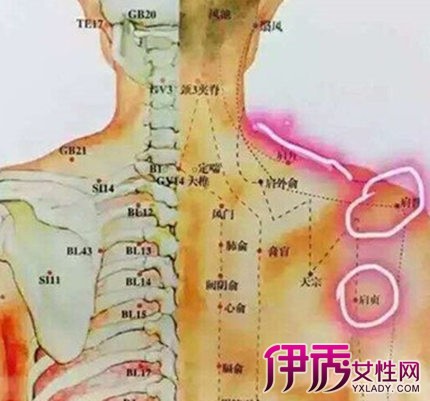 【图】肩周炎拔火罐穴位图片展示 揭秘肩周炎患者4个注意事项