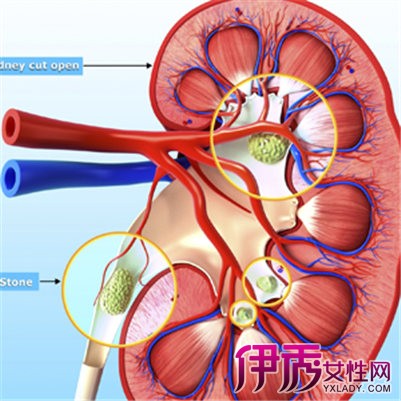 【肾结石加肾囊肿严重吗】【图】患有肾结石加