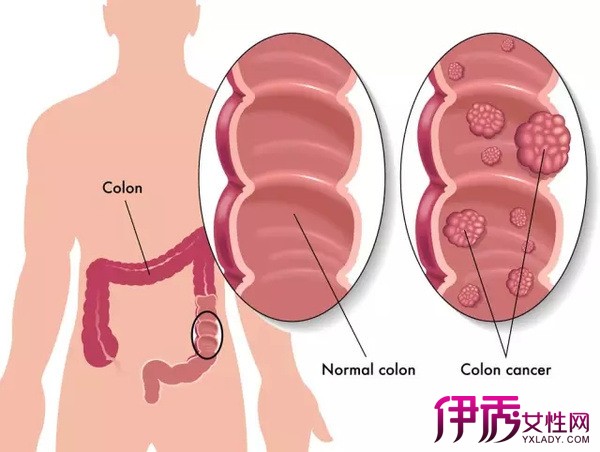 【息肉治疗】【图】息肉治疗怎么做 息肉患者