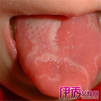 舌苔和念珠菌舌头区别在哪里 专家给出专业意见及指导方法