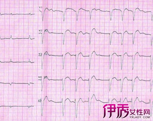 【图】帮你分析心房颤动心电图波形 介绍5种心电图波形给你
