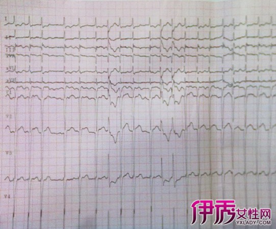 【图】帮你分析心房颤动心电图波形 介绍5种心电图波形给你