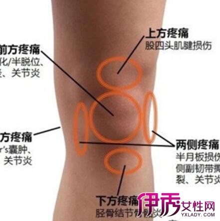 【图】膝盖扭伤治疗方法有哪些 治疗半月板受