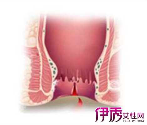 【大便拉出血是上火吗】【图】大便拉出血是上