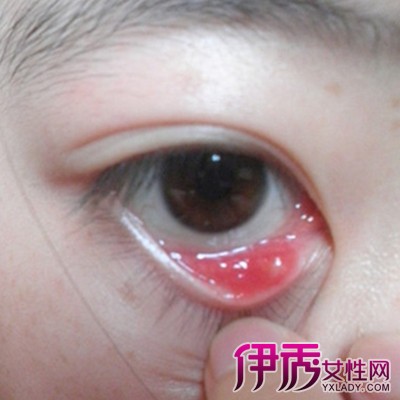 长眼疖子有什么症状?