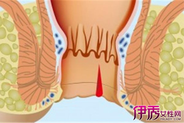 【图】轻微的肛裂会自己好吗 让科学知识来告诉你