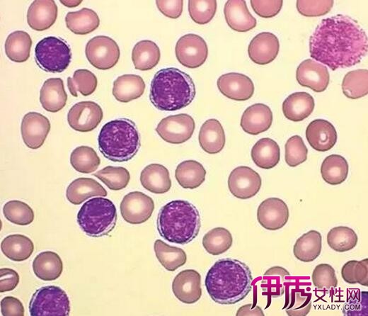 【图】白血球高是什么原因 告诉您正常人白细胞总数是多少