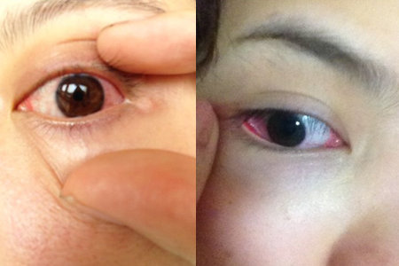 眼睛发炎怎么治疗 让你快速好起来