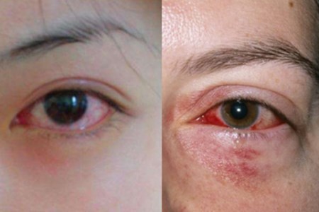 是眼睛周围接触了不卫生的东西导致了发炎的症状,主要表现为,眼睛红肿
