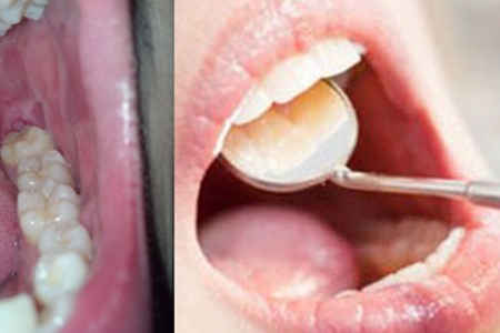 【图】智齿后面牙龈长肉芽是怎么回事 应该采取什么措施