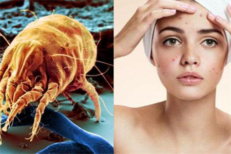 【图】怎么鉴别螨虫真菌引起的皮肤病 怎么治疗见效快