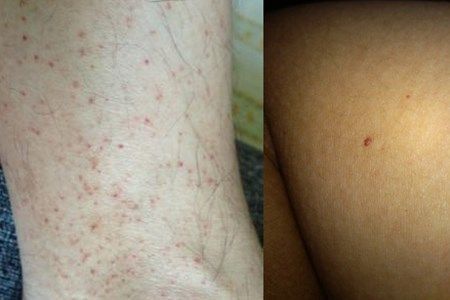 【图】皮肤上有小红血点怎么办 5种可能病因要了解
