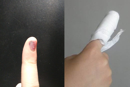 指甲里有淤血可以自己放血吗 正确的处理方式应该是这样