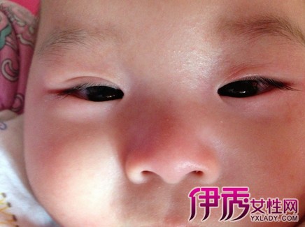 宝宝3岁他眼皮肿有一周会是肾炎吗
