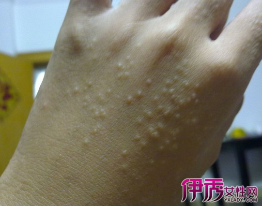 手起水泡很痒怎么办 对付汗孢疹的8大措施