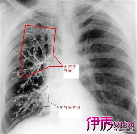患者女性,63岁,因支气管扩张合并肺部感染,左心心力衰竭入院治疗,入院