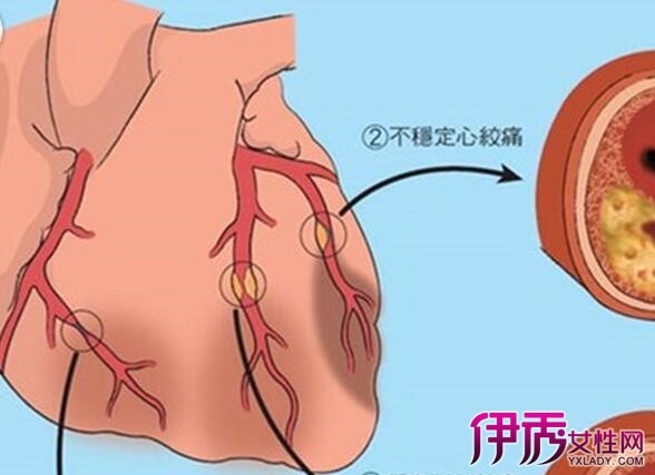 不稳定型心绞痛伴焦虑患者超敏c反应蛋白,血小板参数变化及其临床意义