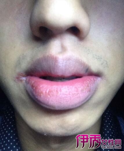 【图】嘴唇发紫红是什么原因 7大措施让你拥有健康唇色