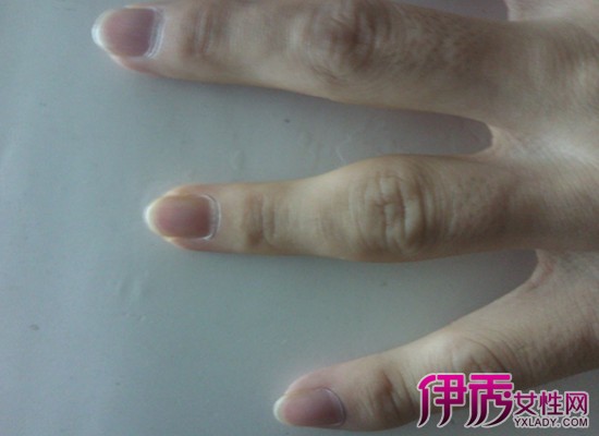 单个手指关节肿痛怎么治