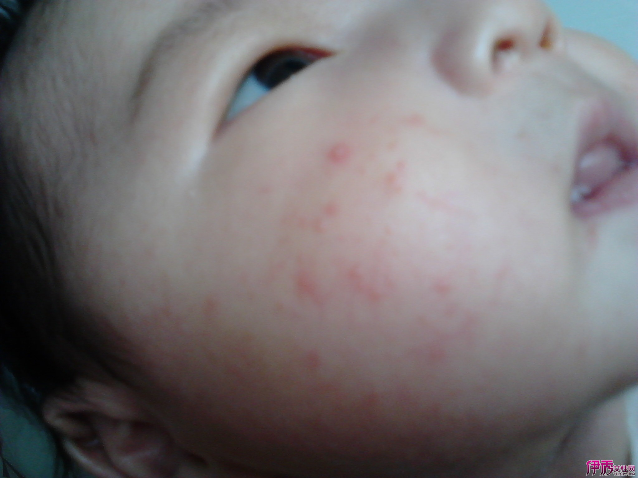 宝宝湿疹初期图片,宝宝湿疹图片初期 - 伤感说说吧