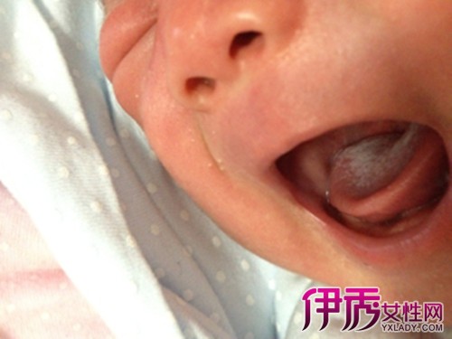 【图】婴儿舌头上有白苔是怎么回事 几步教你