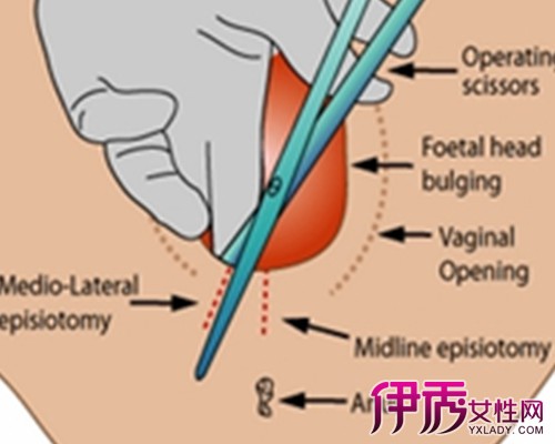 【图】顺产侧切伤口缝针图展现 盘点侧切的几个步骤