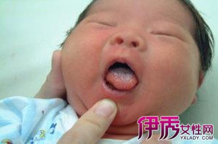 【图】婴儿口腔鹅口疮图片 如何治疗婴儿口腔