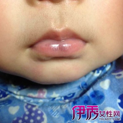 宝宝肺炎嘴唇发紫图片图片