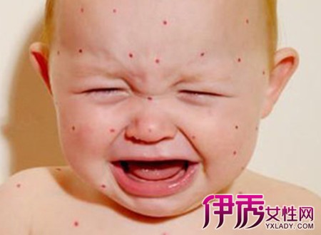 【图】宝宝麻疹症状图片参看 3大麻疹症状早发