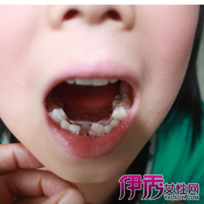 【图】小孩牙齿长歪怎么办 牙齿矫正并不是唯一的方法