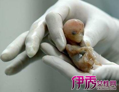 三个月引产胎儿图图片