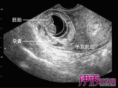 【图】怀孕早期胎芽每天长多少 胎芽的发育过程变化