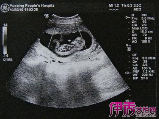 【图】从b超胎儿趴着躺着确定性别 教你孕期注意事项