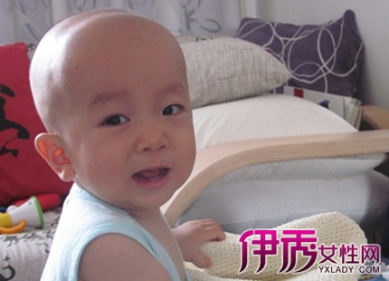 【图】婴儿方颅能治好吗 引起宝宝方颅的原因