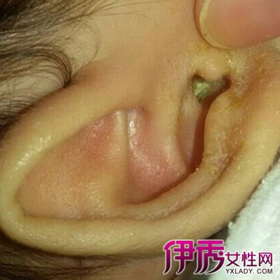 婴儿中耳炎初期图片图片