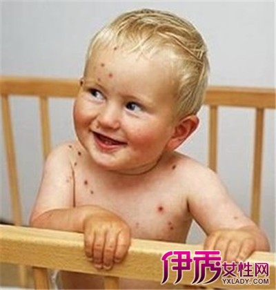 【图】小孩初期出水痘图片展示 介绍其症状及
